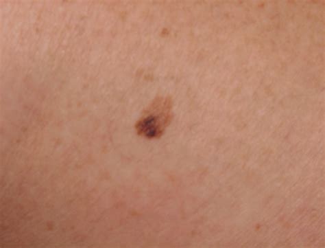 pictures of small melanomas